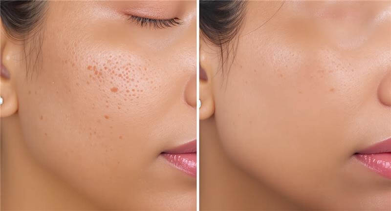 Before and after open pores treatment showing enlarged pores reduced to smoother