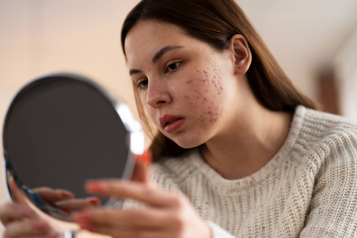 women with acne