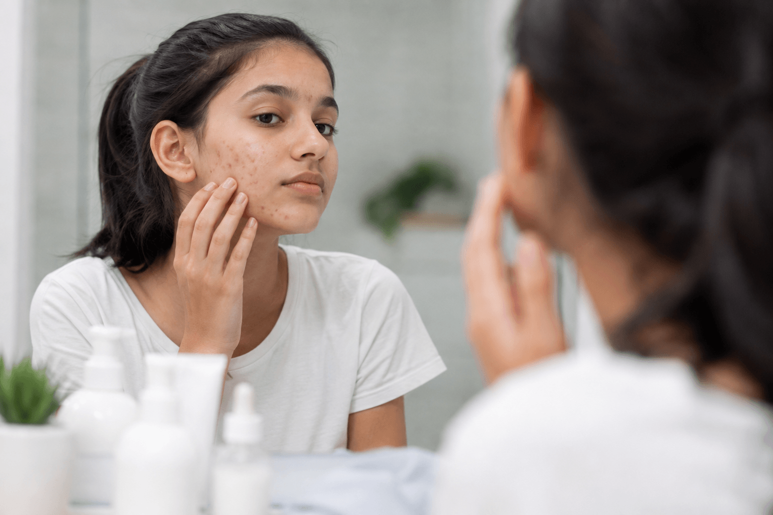 What Causes Teenage Acne?